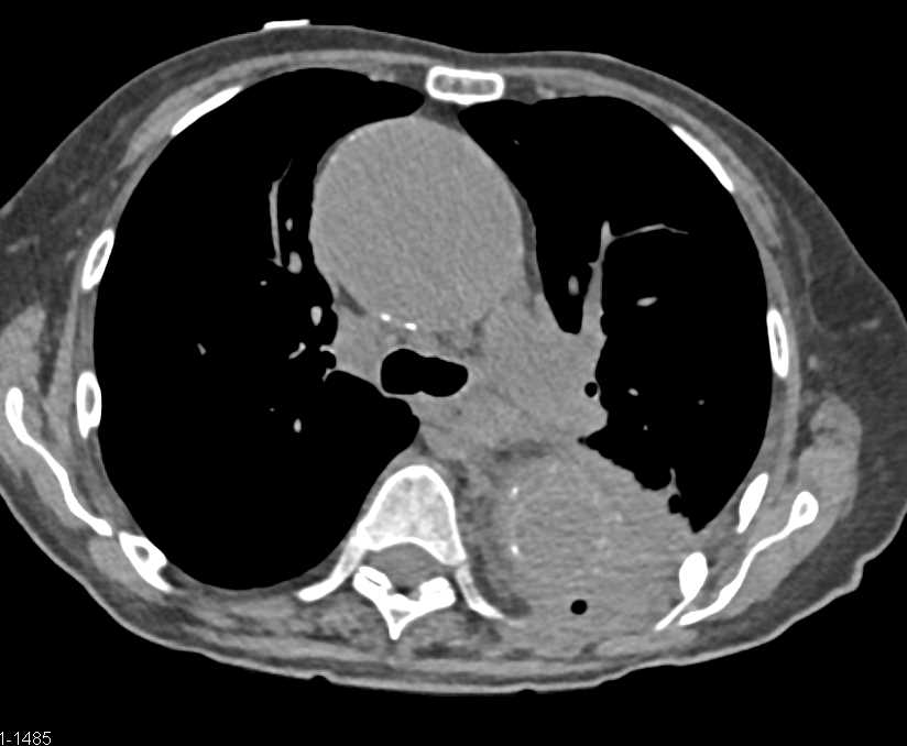 Ulcerating Aneurysm Descending Thoracic Aorta - CTisus CT Scan