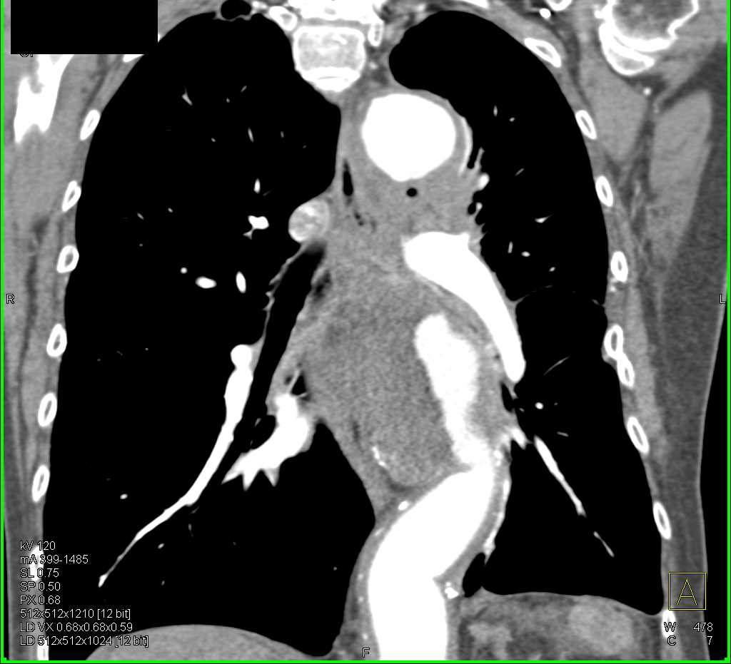 Ulcerating Aneurysm Descending Thoracic Aorta - CTisus CT Scan