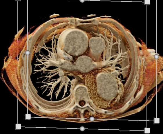 Ulcerating Aneurysm Descending Thoracic Aorta - CTisus CT Scan