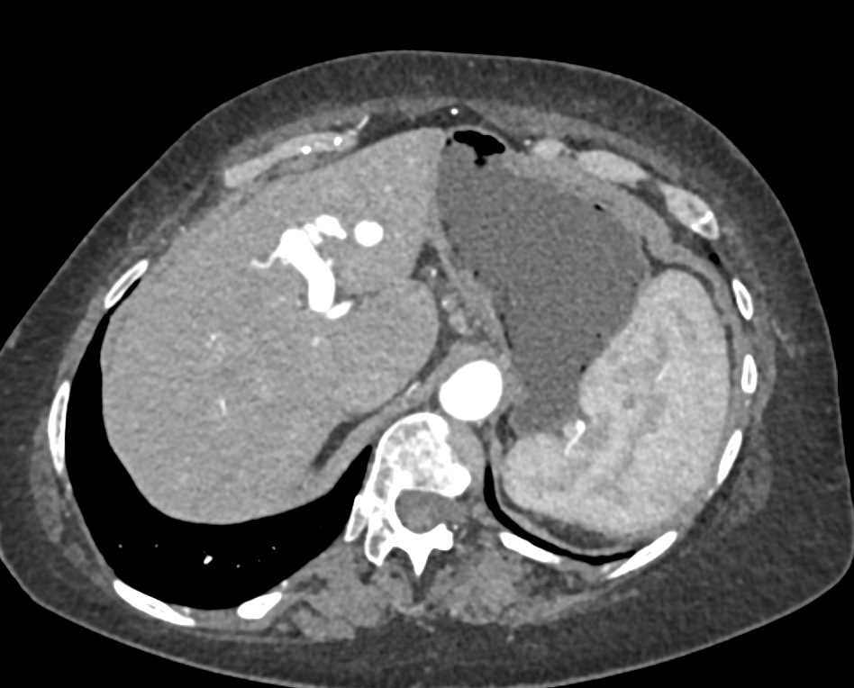 Arteriovenous (AV) Fistulae Liver - CTisus CT Scan