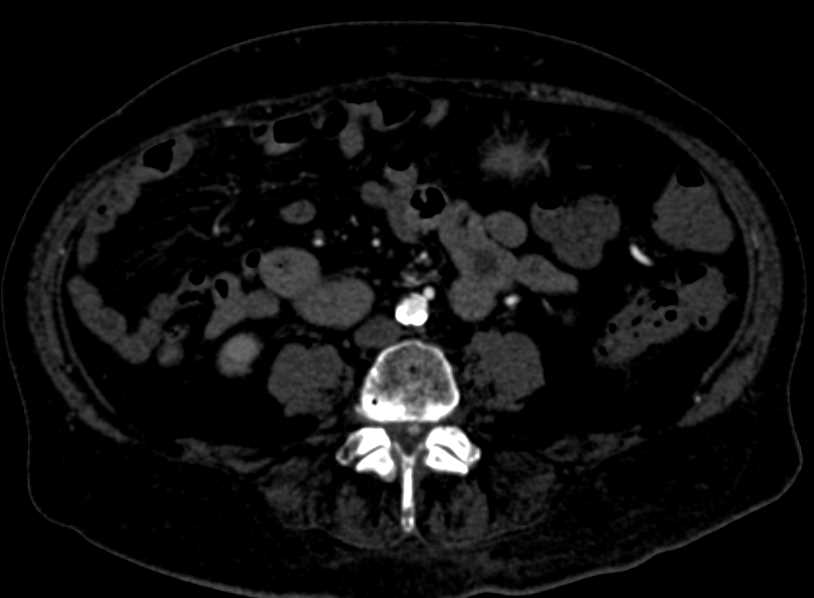 Extensive PAD - CTisus CT Scan