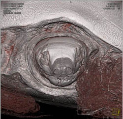 Followup After Plate Is Removed - CTisus CT Scan