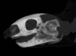 Fracture of Mandible and Orbit Post Repair - CTisus CT Scan