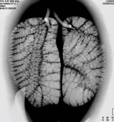 Nice Turtle Lung - CTisus CT Scan