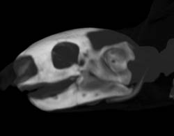 Orbital Fracture - CTisus CT Scan