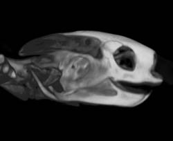 Orbital Fracture - CTisus CT Scan