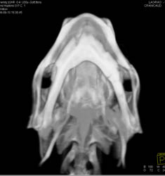 Orbital Fracture - CTisus CT Scan