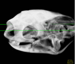 Orbital Fracture - CTisus CT Scan