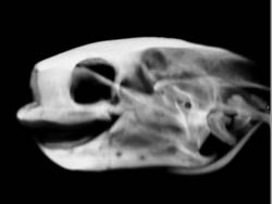 Orbital Fracture - CTisus CT Scan