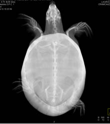 Orbital Fracture - CTisus CT Scan