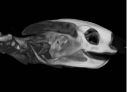 Orbital Fracture - CTisus CT Scan