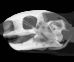 Orbital Fracture - CTisus CT Scan