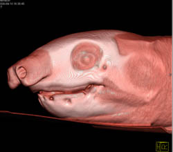 Orbital Fracture - CTisus CT Scan