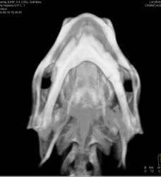 Orbital Fracture - CTisus CT Scan