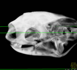 Orbital Fracture - CTisus CT Scan