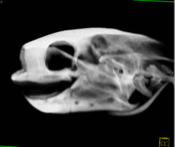 Orbital Fracture - CTisus CT Scan