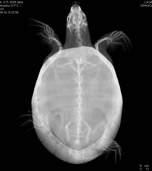 Orbital Fracture - CTisus CT Scan