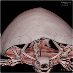 Normal Scapula - CTisus CT Scan