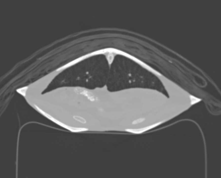 3D Turtle Without Abscess - CTisus CT Scan