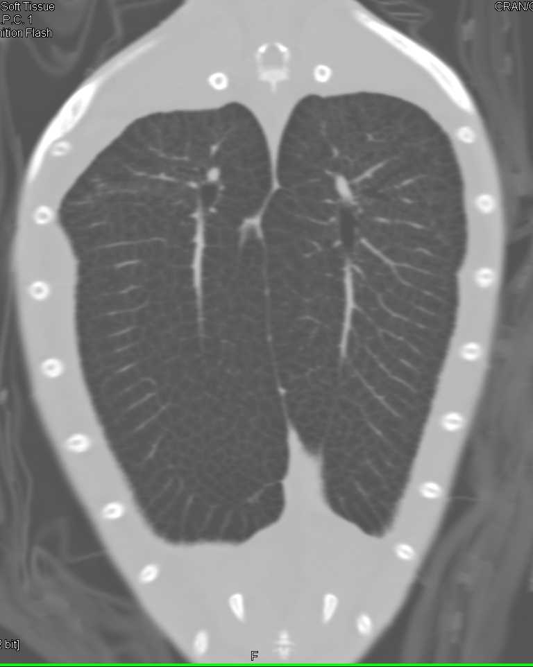 3D Turtle Without Abscess in the Lungs (or anywhere) - CTisus CT Scan