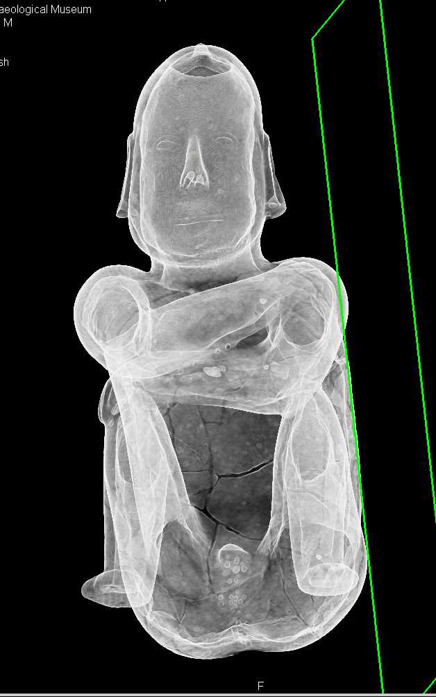 3D of Mummy from the Hopkins Museum - CTisus CT Scan