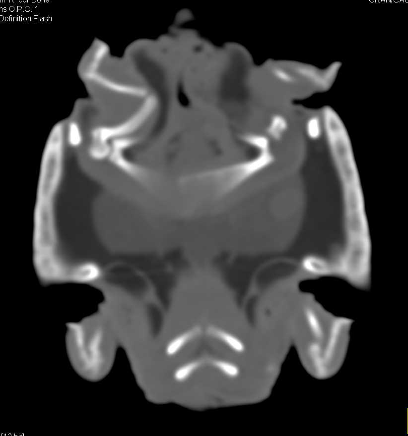 Osteomyelitis Left Shoulder Joint in a Mud Turtle - CTisus CT Scan