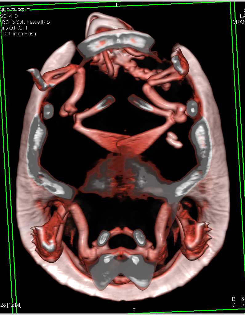 Osteomyelitis Left Shoulder Joint in a Mud Turtle - CTisus CT Scan