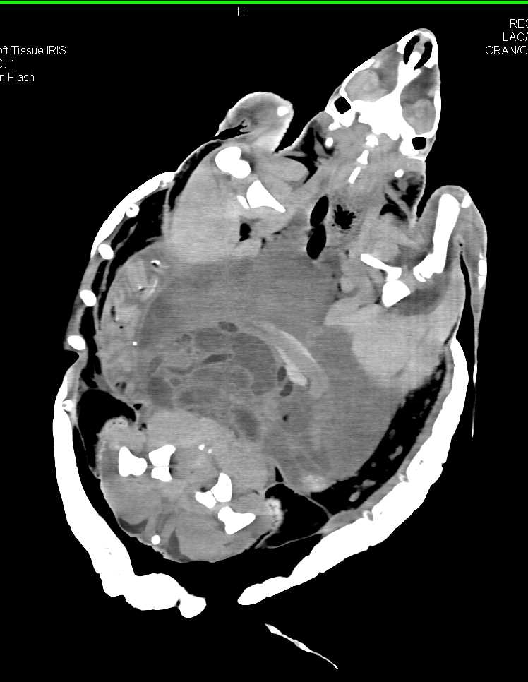 Ridley Turtle with Osteomyelitis Proximal Right Humerus - CTisus CT Scan