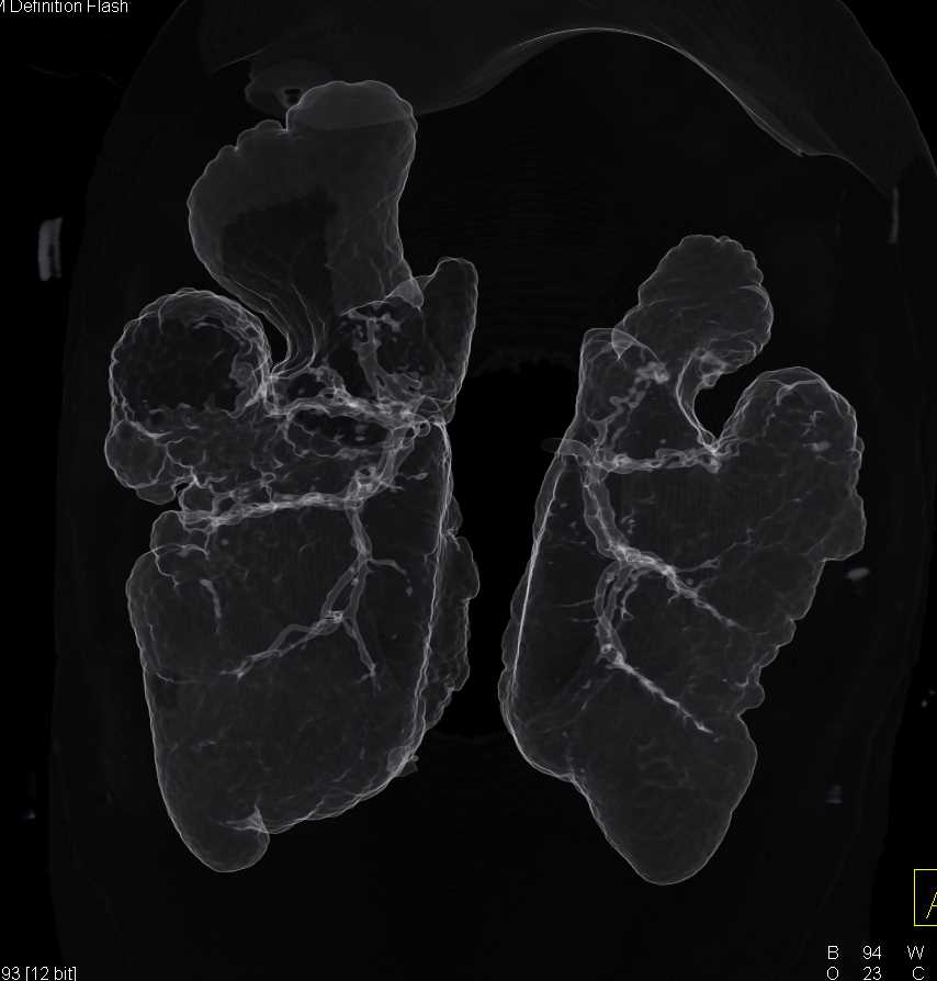 3D Imaging of the Airways of a Turtle - CTisus CT Scan