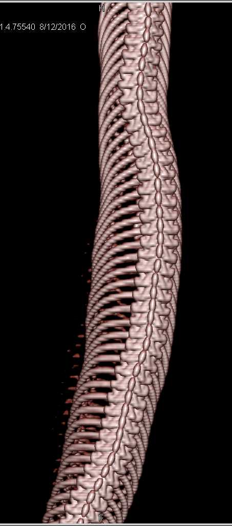 CT of a Boa Constrictor Who Has Lots of Ribs - CTisus CT Scan