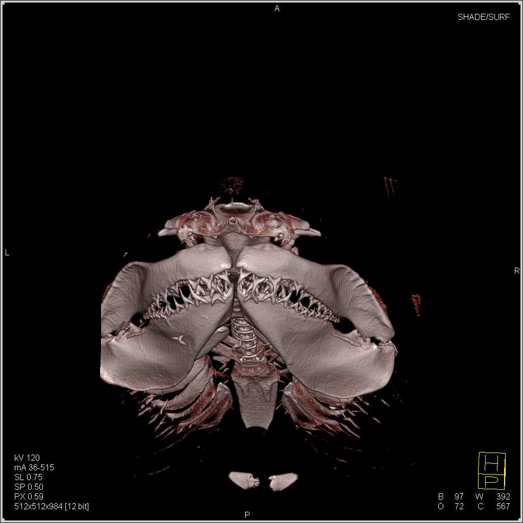 Sand Tiger Shark that ate a Fish - CTisus CT Scan