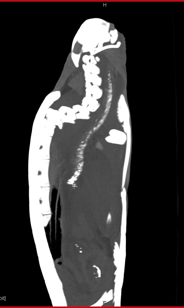 Turtle with Esophagitis - CTisus CT Scan