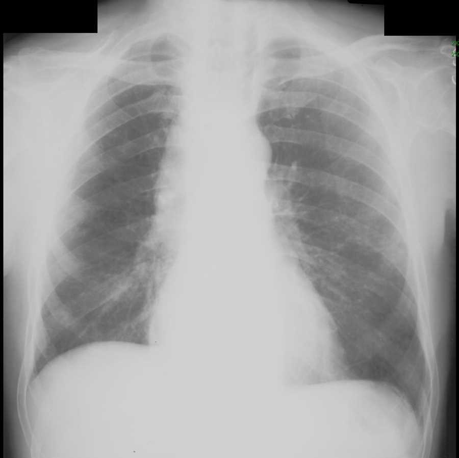 Achalasia on Chest X-ray - CTisus CT Scan