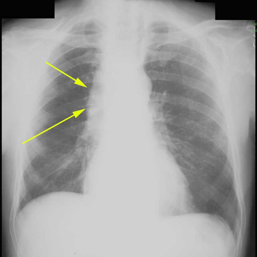 chest x ray case study