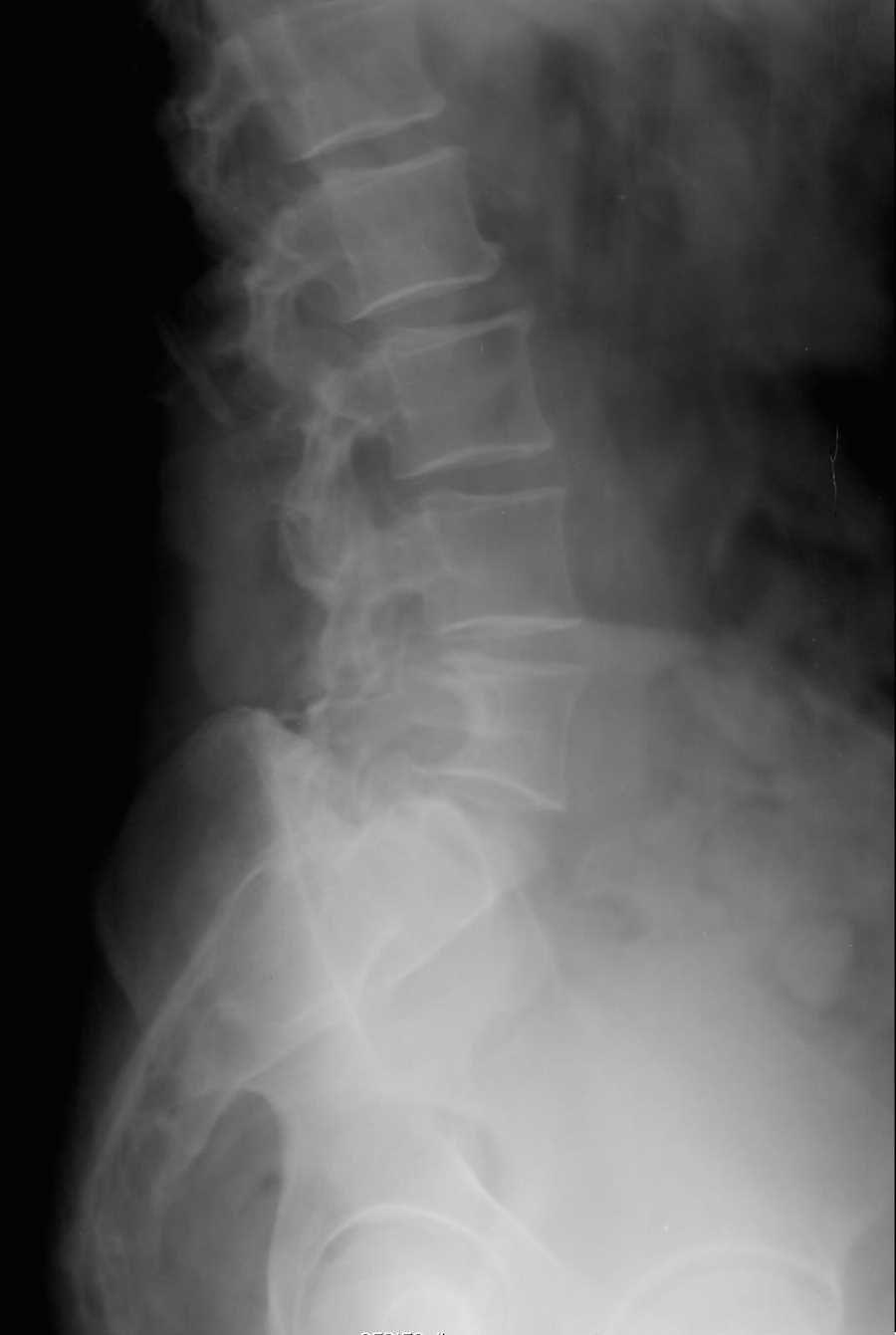 Astrocytoma Causing Scalloping of the Lumbar Vertebral Body - CTisus CT Scan