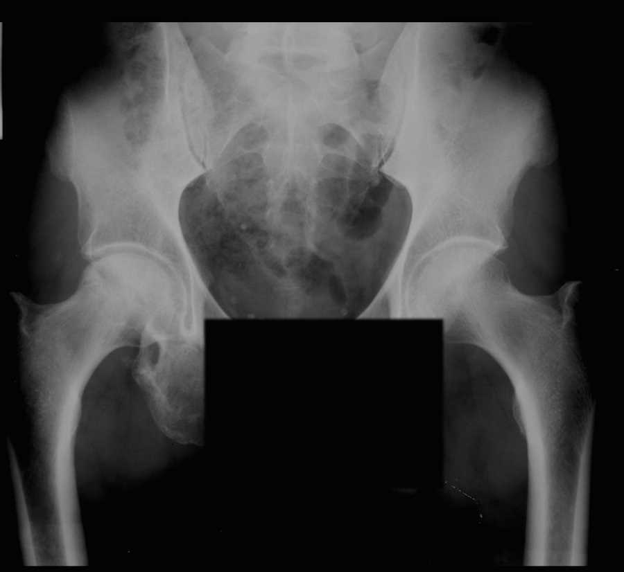 Avascular Necrosis (AVN) Femoral Head on X-ray - CTisus CT Scan