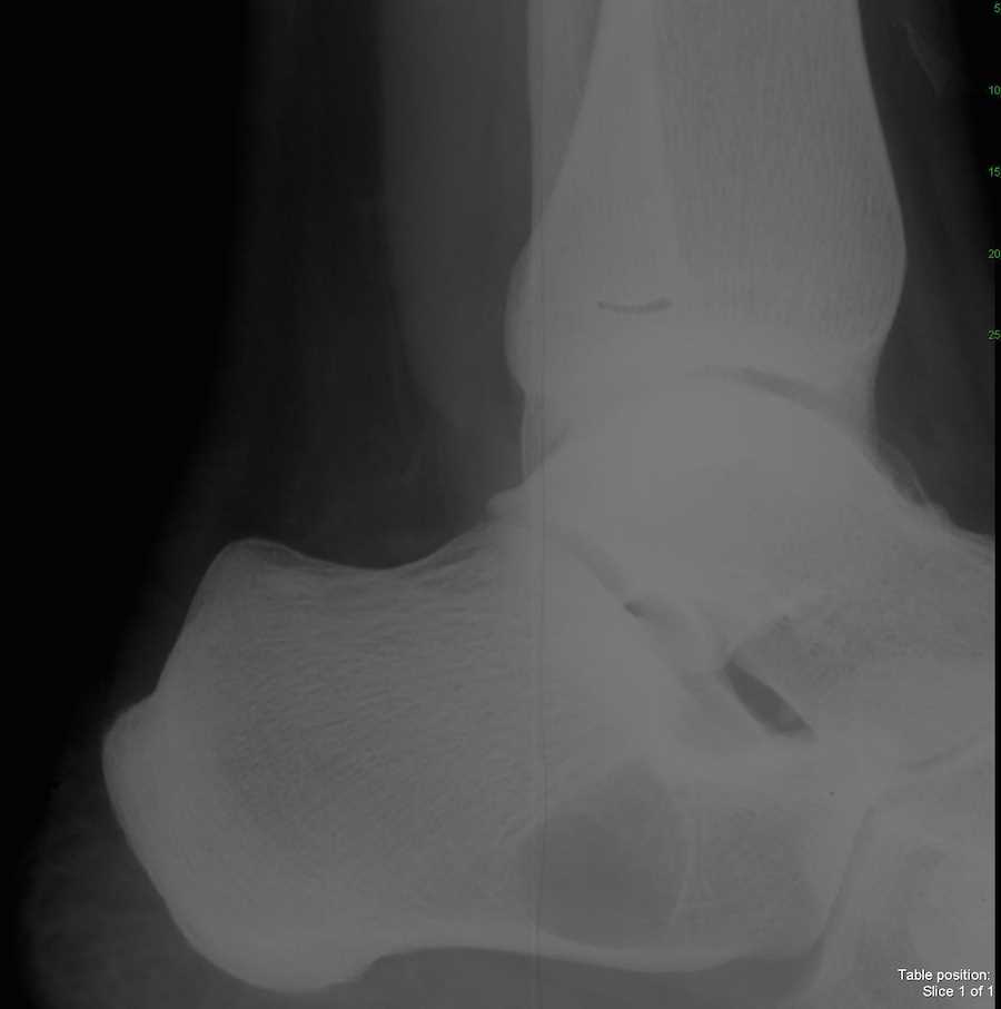 Bone Cyst in Calcaneus on X-ray - CTisus CT Scan