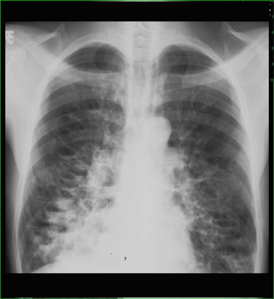 Cystic Bronchiectasis on Chest X-ray - CTisus CT Scan
