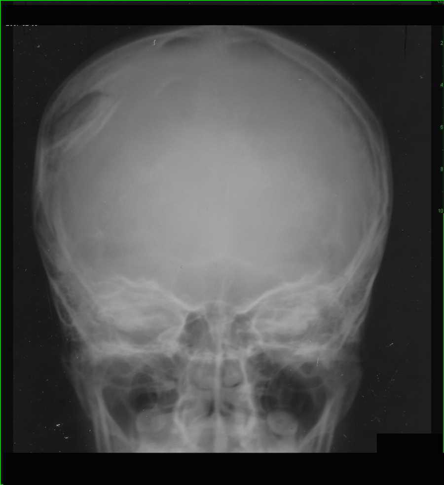 Depressed Skull Fracture on X-ray - CTisus CT Scan