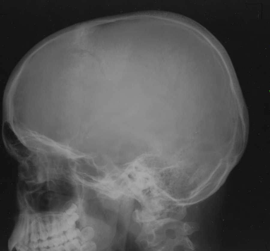 Lisfranc Fracture Dislocation X Rays Case Studies Cti - vrogue.co