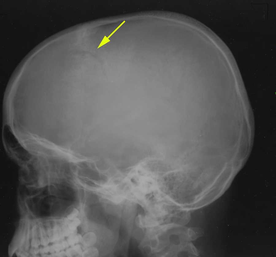 Cranial Fracture