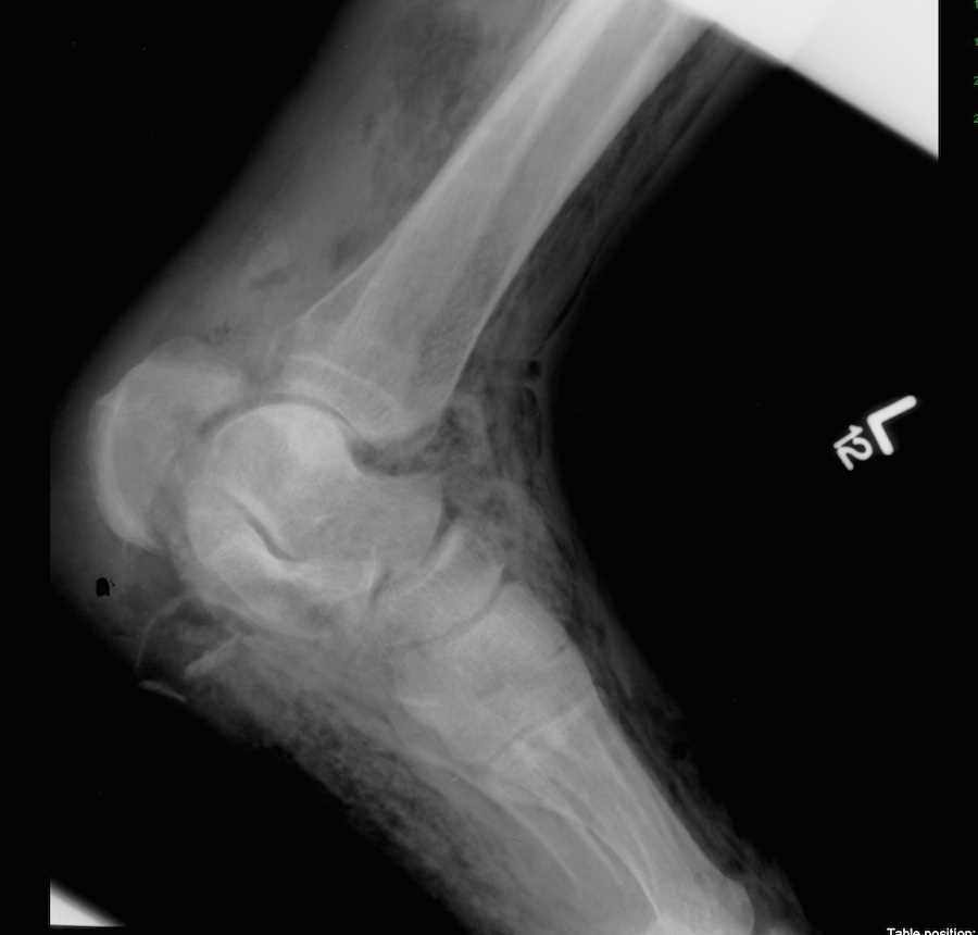 Gangrene of the Foot with Soft-Tissue Gas on X-ray - CTisus CT Scan