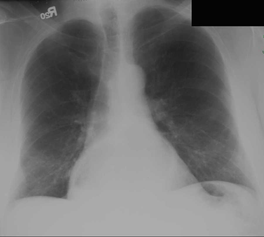 paraesophageal hernia x ray