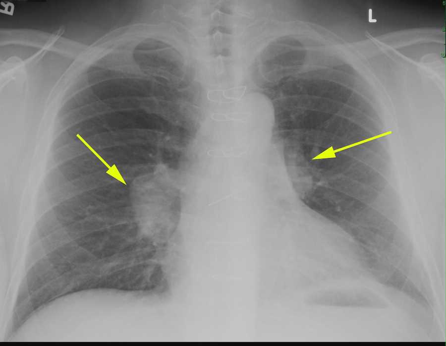 Hilar Adenopathy on Chest X-ray - X Rays Case Studies - CTisus CT Scanning