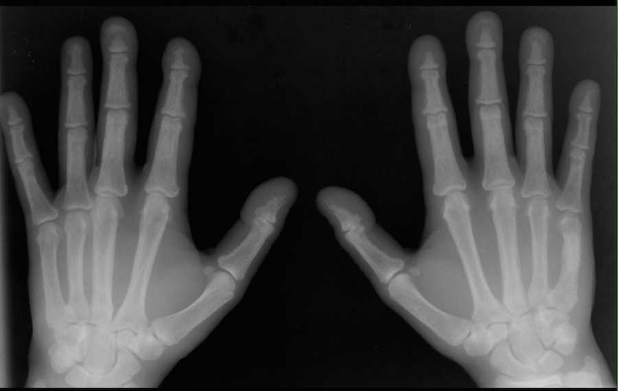 Hyperparathyroidism on Hands on X-ray - CTisus CT Scan