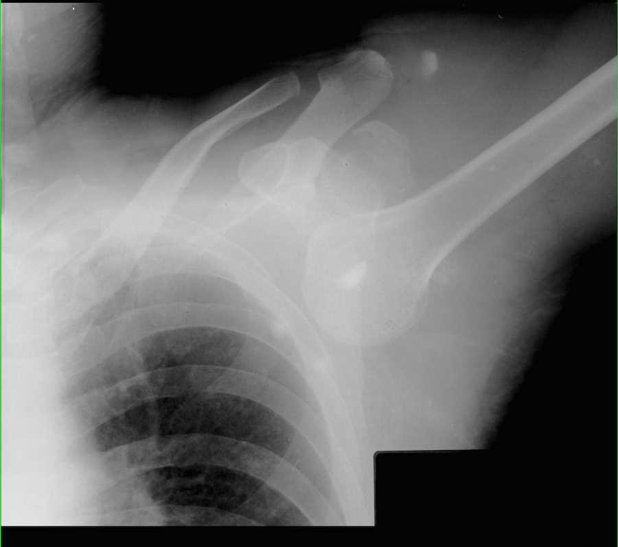 Left Shoulder Dislocation on X-ray - CTisus CT Scan