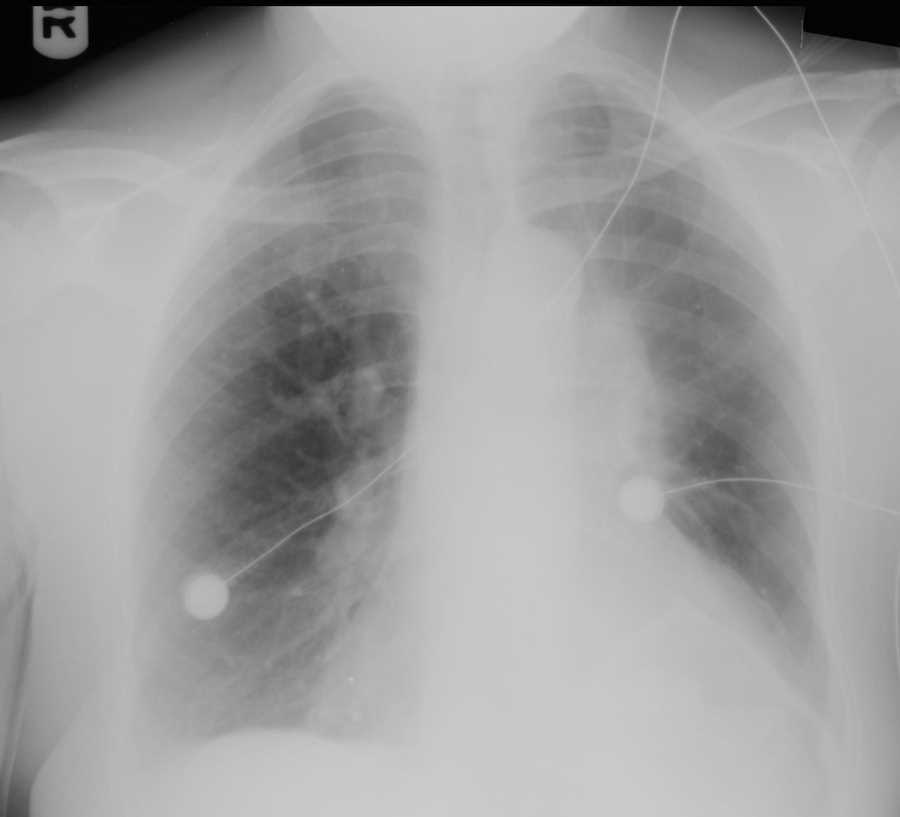 Left Upper Lobe Atelectasis on Chest X-ray - CTisus CT Scan