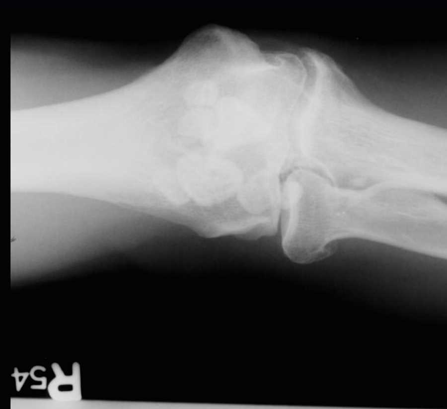 Loose Bodies in Elbow Joint on X-ray - CTisus CT Scan