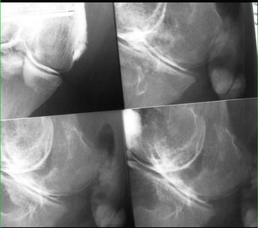 Medial Meniscus Tear on Arthrogram - CTisus CT Scan