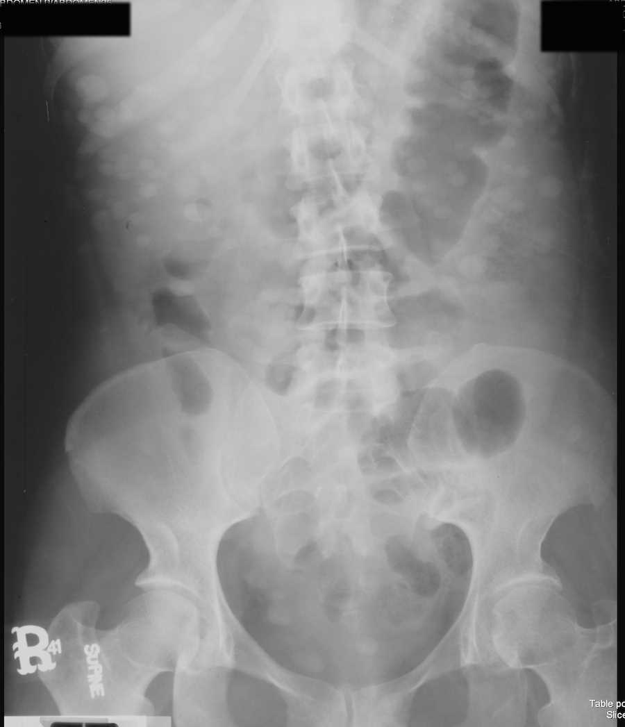 Neurofibromatosis on Abdominal X-ray - CTisus CT Scan